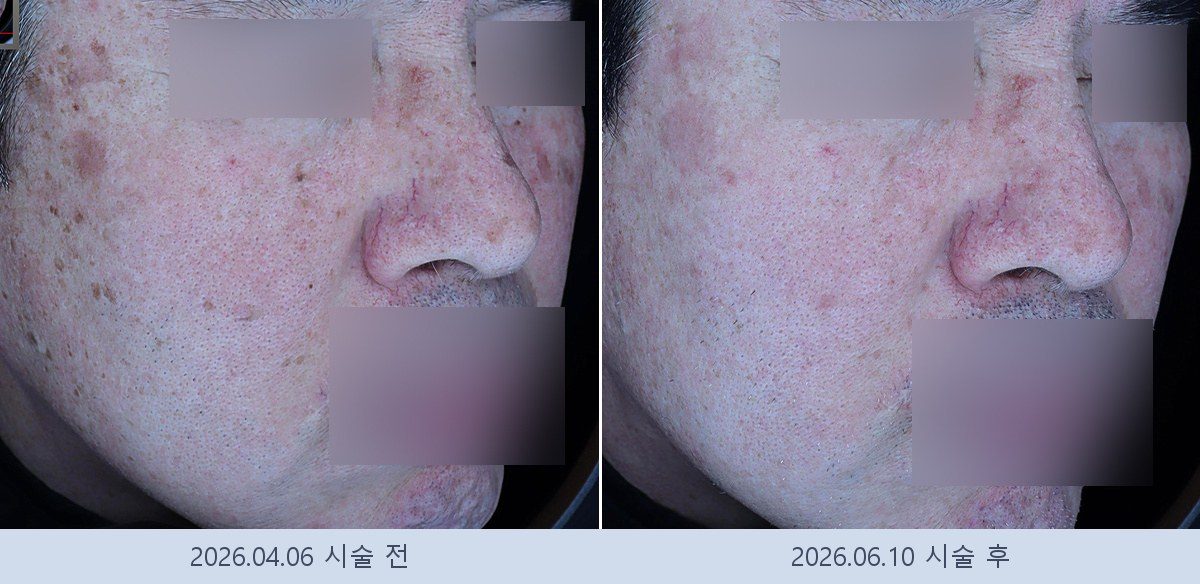 흑자 검버섯
