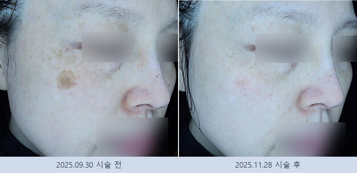 기미 잡티