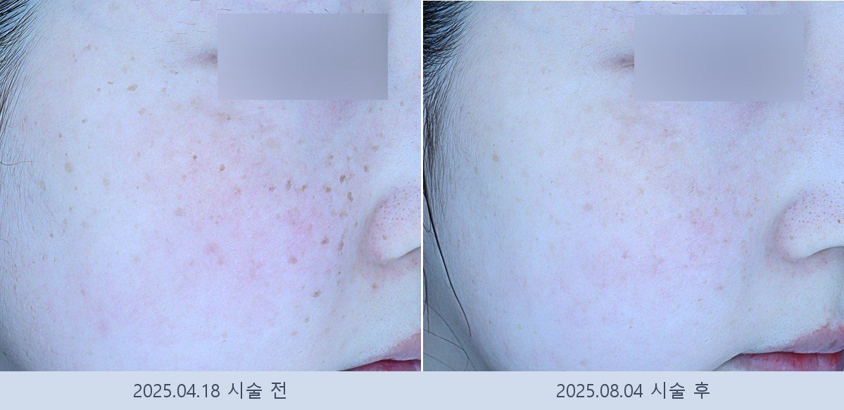 기미 잡티